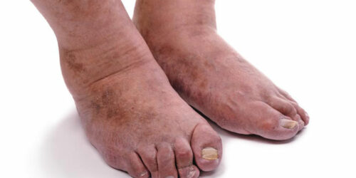 4 important things you need to know about rheumatoid arthritis