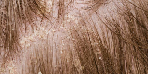 A brief overview of scalp psoriasis