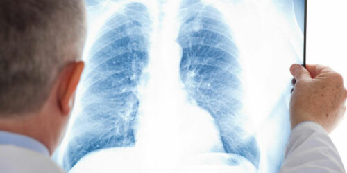 A few things you should know about mesothelioma cancer