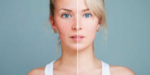 All You Need to Know About Rosacea