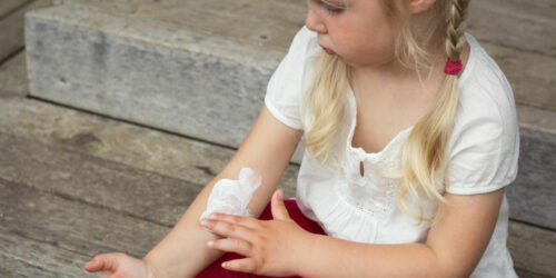 Here’s how you can manage atopic dermatitis