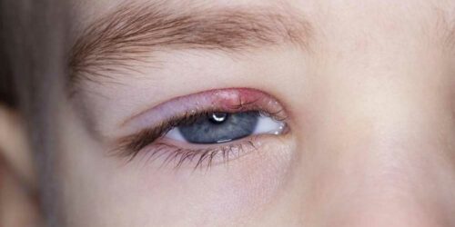 Know about the Symptoms and Causes of Eyelid Inflammation