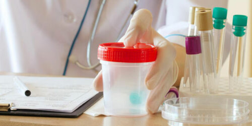 Proteinuria – The process of protein in urine test