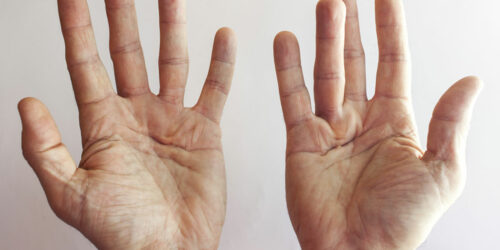 4 hand exercises for Dupuytren’s contracture patients