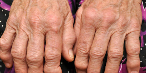 10 Effective Ways to Get Instant Pain Relief from Gout