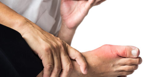 Common Risks and Causes of Gout