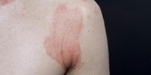 Contact Dermatitis – Symptoms, Causes, and Treatment Options