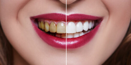 Dental veneers’ cost, procedure, and results