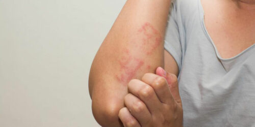 Eczema – Types, Causes, Symptoms, and Treatment