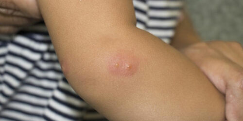 Here’s What You Need to Know about Shingles and Its Symptoms