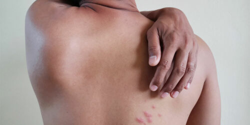 Shingles – Treatment options and preventive measures