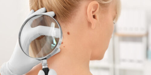 Worried About Skin Cancer Here’s What To Know