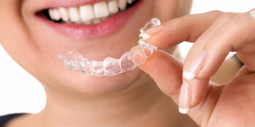An overview of invisible teeth aligners braces