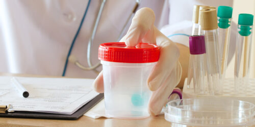 Cloudy Urine – Causes and Home Remedies